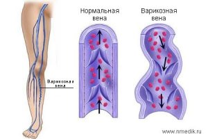 Варикозное расширение вен - снижение тонуса сосудов